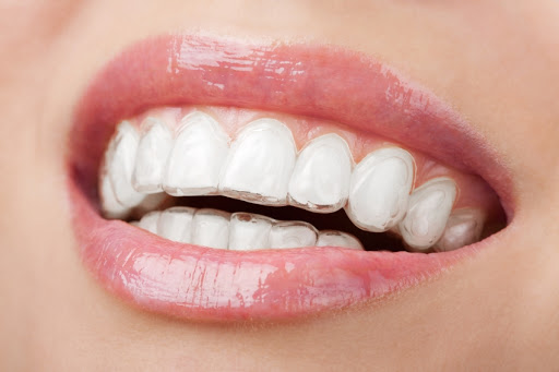 invisalign elche