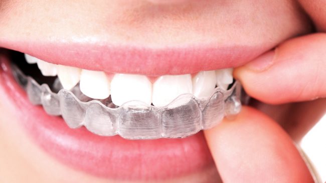 invisalign elche