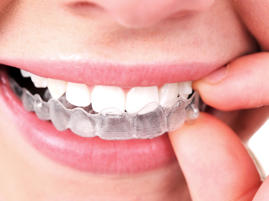 invisalign elche