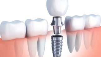 implantes dentales en elche